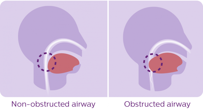 Sleep Apnea Diagram - Island Respiratory Specialists